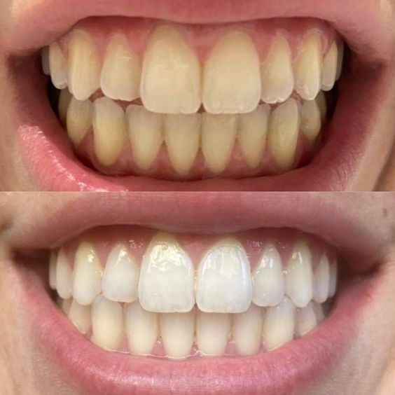 Comparison of teeth before and after whitening, showing significant improvement in teeth color and brightness.