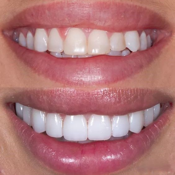 Before and after comparison of a person's smile showing dental improvement with teeth alignment and whitening.