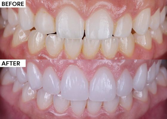 Before and after comparison of teeth showing the effects of a dental whitening treatment.